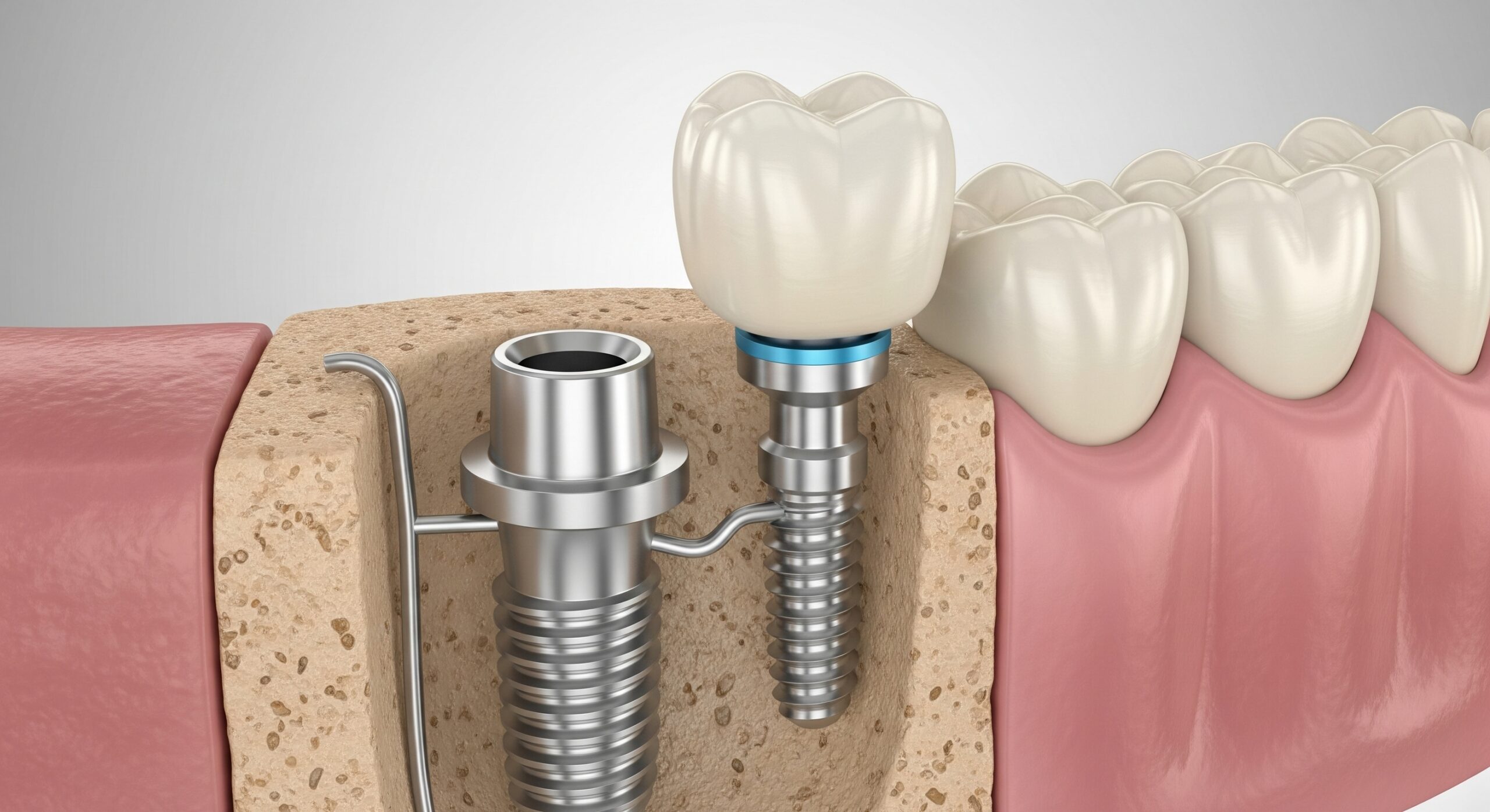 3D illustration of two dental implants in the jawbone, one with a crown and one prepared for restoration.