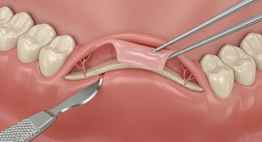 3D illustration of a sinus lift procedure showing gum flap elevation and access to the sinus membrane.
