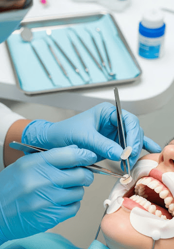 Dentist placing a dental veneer on a patient’s tooth using precision tools during a cosmetic treatment procedure.
