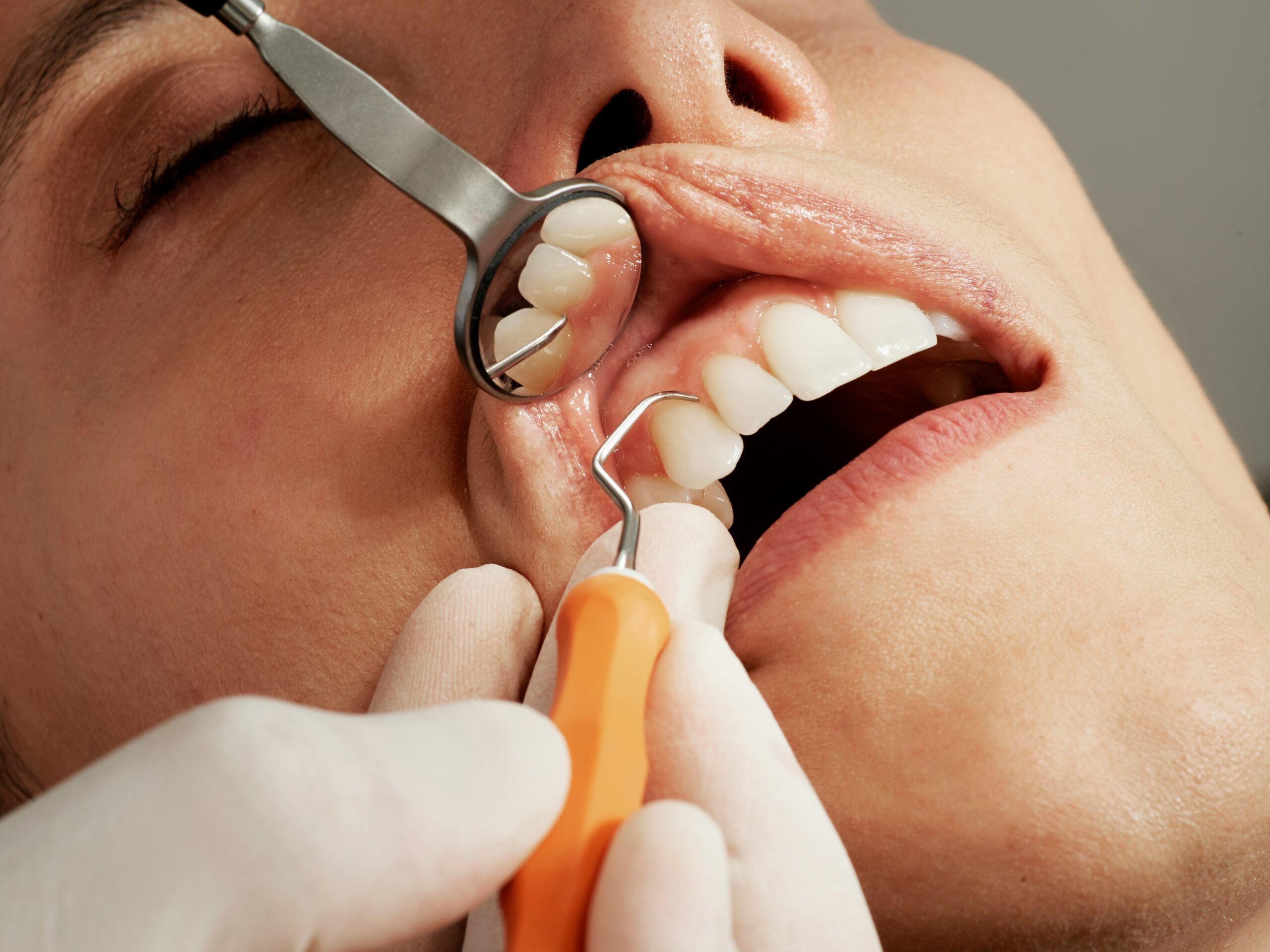Close-up of a dental exam showing tools inspecting a patient’s teeth and gums.
